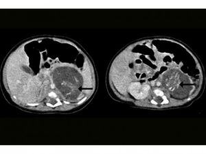Hong Kong: Doctors remove ‘twin foetuses’ from newborn baby girl