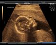Ultrasound scan images reveal harmful effects of smoking during pregnancy