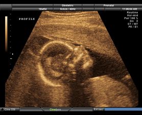 Ultrasound scan images reveal harmful effects of smoking during pregnancy