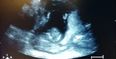 WATCH: Incredible scan film shows baby clapping along with mum’s singing