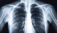 Hundreds of patients recalled after X-ray errors