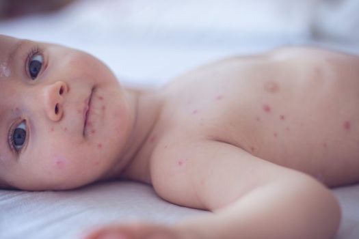 measles vaccinations immunisation anti-vaxxers