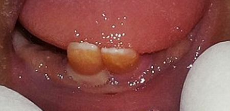 Twins BOTH born with front teeth, breastfeed anyway