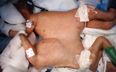 MIRACLE: Youngest Ever Conjoined Twins Separated