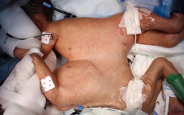 MIRACLE: Youngest Ever Conjoined Twins Separated