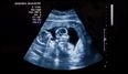 Doctors Confirm Twins ‘Have Different Fathers’