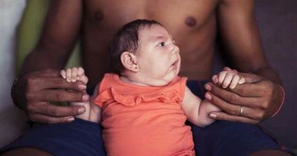 CONFIRMED: Zika Virus DOES Cause Birth Defects