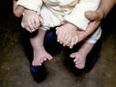 Parents Seek Help for Baby Born With 15 Fingers and 16 Toes