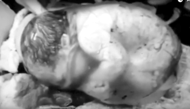This Video Of A Baby Born Still In The Amniotic Sack Is A Sneak Peak Of Life Inside The Womb