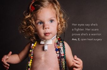Beautiful Photo Series Shows Kids Proudly Showing Off Their Scars