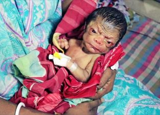 The Newborn ‘Miracle’ Baby Who Looks Like An 80-Year-Old