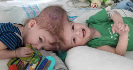 Conjoined Twin Boys Successfully Separated At New York Hospital