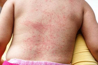 Irish parents advised to be vigilant for signs of Scarlet Fever after UK outbreak
