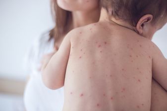WHO warns of massive measles outbreak in Europe as more than 500 cases are reported in January