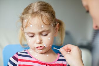 Calls for chickenpox vaccine to be made available for all children in Ireland