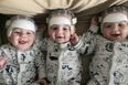 Medical history for triplets who underwent surgery for rare condition