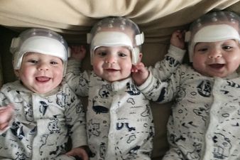 Medical history for triplets who underwent surgery for rare condition