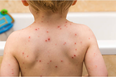 Chickenpox: the common virus that no parent should be complacent about