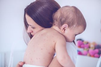 Things you should (and shouldn’t) do if your child gets a dose of chicken pox
