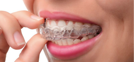 A new study explains why you should be wearing your retainer for the rest of your life