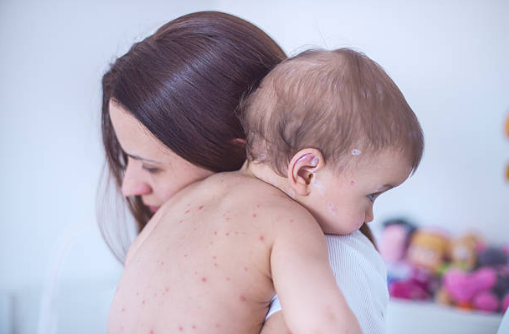 HSE issues measles warning over two new cases in Dublin