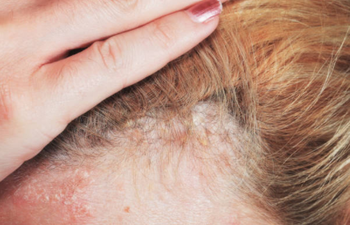 Woman claims her psoriasis disappeared after using €5.30 baby moisturiser