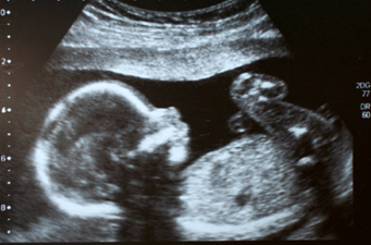 People are getting their ultrasound scans painted onto their nails