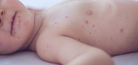 Measles outbreak in Donegal spreading with at least seven confirmed cases