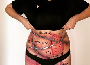 Irish singer RuthAnne shines a light on endometriosis with a powerful bodypaint picture