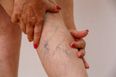 Varicose veins and women: How do you recognise them and can you avoid them?