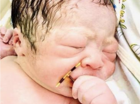 baby born holding mother's contraceptive coil