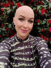 It changed my relationship with beauty: journalist Mary Cate Smith discusses her alopecia journey