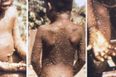 What is Monkeypox? Another rare virus has hit the UK