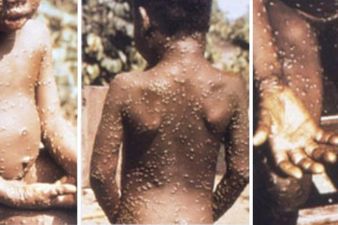 What is Monkeypox? Another rare virus has hit the UK