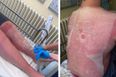 “I am burning from the inside out”: Mum issues stark warning after son suffers extreme sunburn