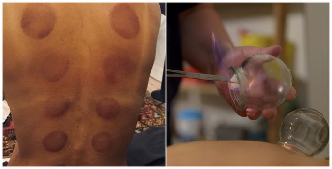 I tried cupping therapy and here is what happened