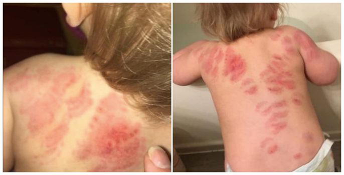 child bitten more than 25 times at creche