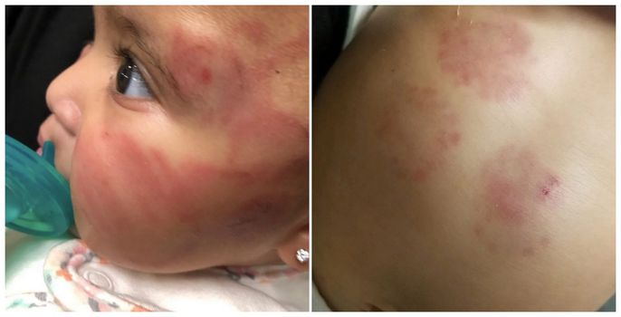 Six-month-old baby left 'covered in bruises' at creche