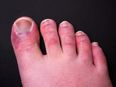 Did you get ‘Covid toes?’ Research shows new side effect of virus