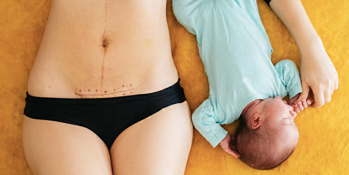 effects of C-sections last long after baby is born