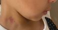 Mum shocked to find hickeys on bullied 6-year-old’s neck after school