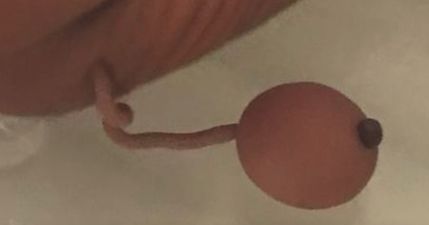 Premature newborn born with human tail