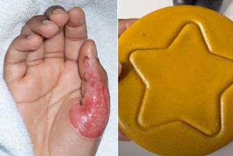 Latest Squid Game-inspired online challenge leaves kids needing skin grafts