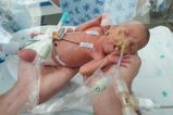 Preemie expected to be born brain dead at 23 weeks now taking first steps
