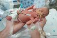 Preemie expected to be born brain dead at 23 weeks now taking first steps