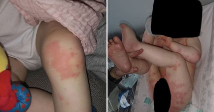 Cork mam warns parents after 1-year-old son is hospitalised with Covid-related rash