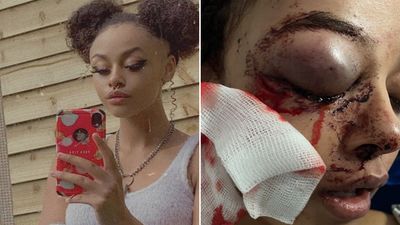 Teenage girl who was brutally attacked in Ballyfermot speaks out