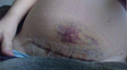 Mum shares photo of C Section scar to prove it is not the ‘easy way out’