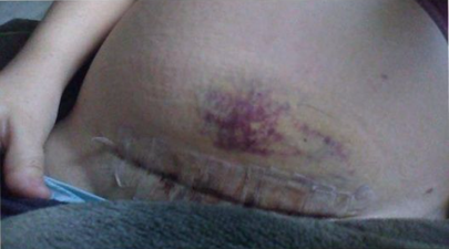 Mum shares photo of C Section scar to prove it is not the ‘easy way out’