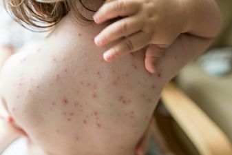 Concerns about increase in chickenpox cases in Ireland